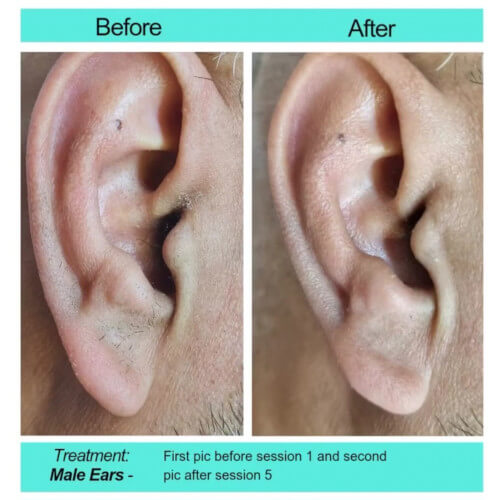 Before and After picture of Male ears